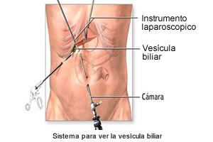 colecistectomia laparoscopica